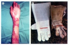 Handverletzungen durch geschrumpften Handschuh